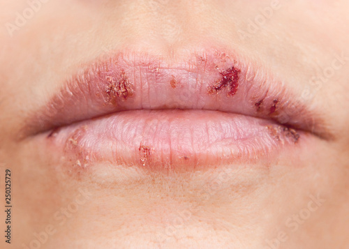 Papier peint Multiple herpes in the form of sores on the lips.