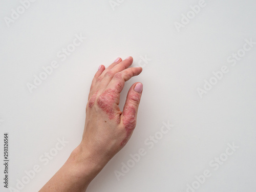 Psoriasis skin. Closeup of rash and scaling on the patient's skin. The concept of chronic disease treatment. Dermatological problems. Hard, horny and cracked skin in woman's hand. Dry skin. Isolated