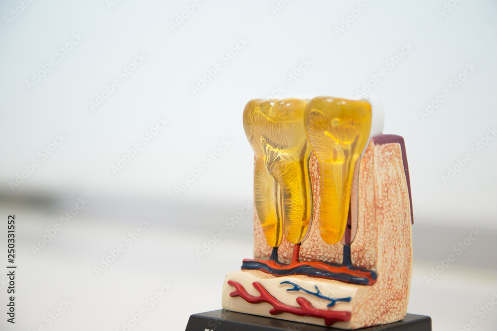 thumbnail image 2 of Detailed Anatomical Diseased Teeth And Gums Model – Dental Hygiene Teaching Tool – Cattelan CL-BL 2 of 4