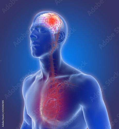 3D illustration of the of the blood vessels in the human brain and cerebrovascular disease or hemorrhagic stroke and causes of a brain stroke