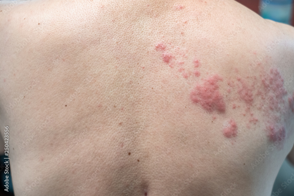 Shingles (Disease), Herpes zoster, varicellazoster virus. skin rash and blisters Stock Photo