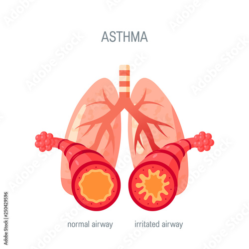 Asthma disease vector icon in flat style