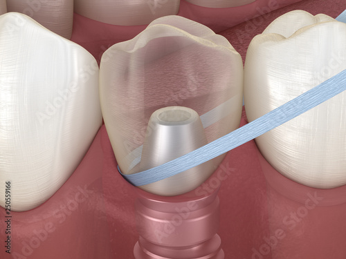 Schilderij op canvas Implant tooth cleaning with dental floss
