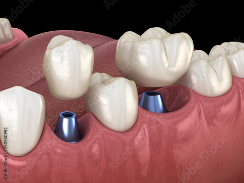 Premolar and Molar tooth crown installation over implant abutments. Medically accurate 3D illustration of human teeth and dentures concept