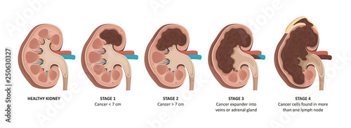 Kidney cancer stages