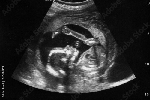 Ultrasound with pregnancy Obstetric of fetus Medical images. pregnant mother. photo