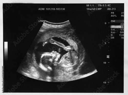 Ultrasound with pregnancy Obstetric of fetus Medical images. pregnant mother.