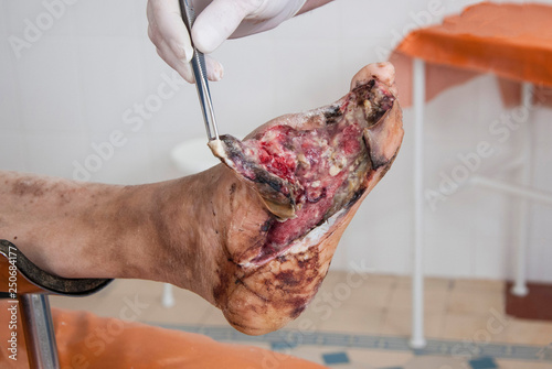 Foot wound becomes infected. Phlegmon of the foot. Purulent wound of the foot. Foot surgery. Diabetic foot syndrome. Patients with diabetes, foot ulcers