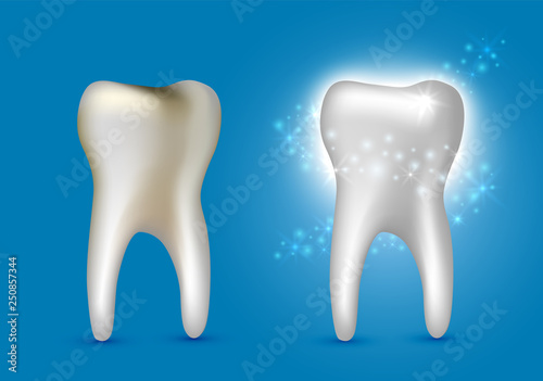 Beautiful realistic dentist vector set of decayed and white shiny cleansed tooth on blue background.