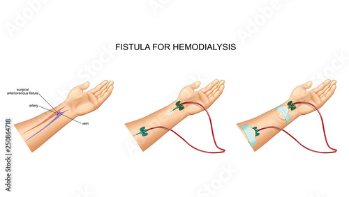 intravenous catheter, hemodialysis and fistula photo