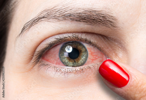 Brown and grey eye of girl close up suffering from redness photo