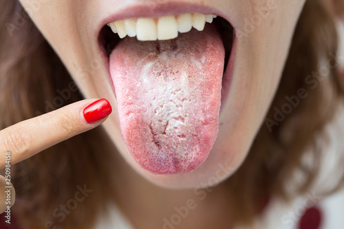 Woman with halitosis for candida albicans pointing her tongue with finger photo