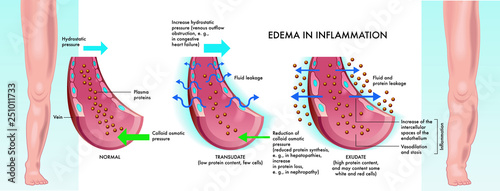 Main stages of edema inflammation illustrated in medical diagram.