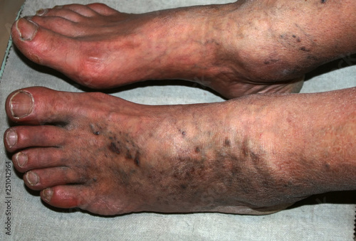 Leg. Varicose veins. Phlebeurysm. Thrombophlebitis. leg in veins
