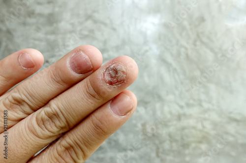 Close up of fungus nail infection. Fungal infection on nails hand, finger with onychomycosis, damage on human hand on gray concrete wall background. Disease and Symptom concept.