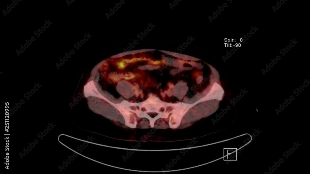 Vidéo Stock PET CT Scan of whole body from head to toe with fusion ...