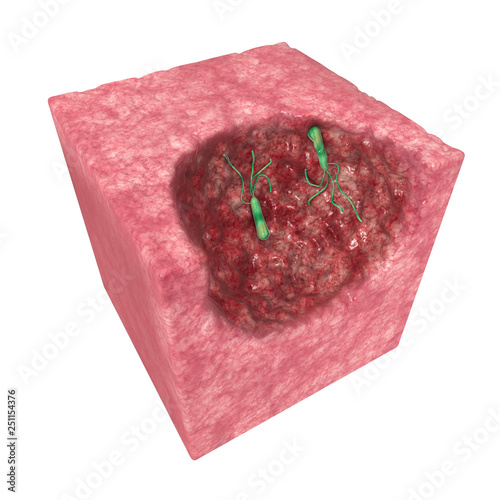 фотографія Helicobacter pylori is a microaerophilic bacterium usually found in the stomach