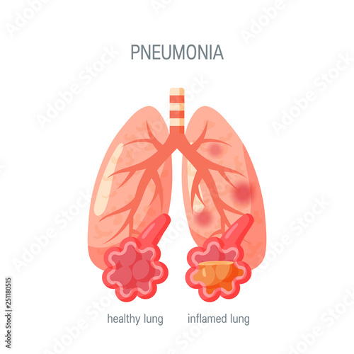Pneumonia disease vector icon in flat style