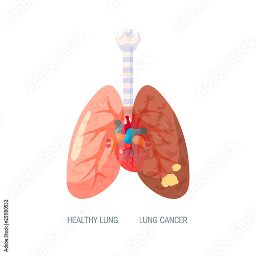 Lung cancer vector concept in flat style