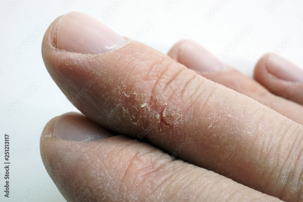 Dry Cracked Skin On Fingers Arms With Dermatology Problems Stock