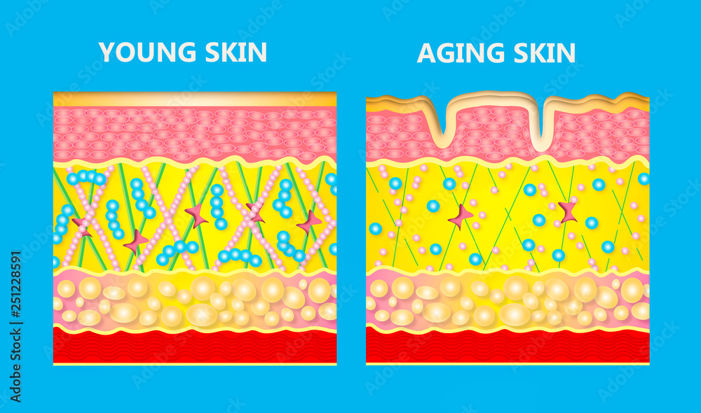 The diagram of younger skin and aging skin Stock Illustration | Adobe Stock