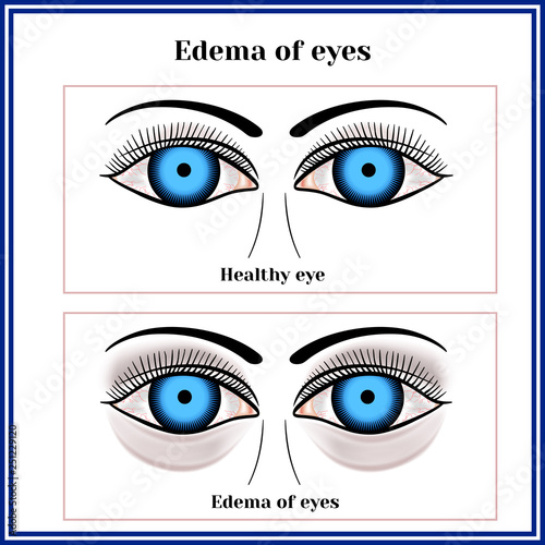 Edema of eyes.