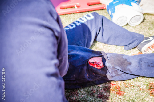 Moulage injuries