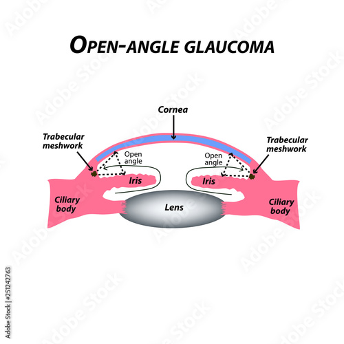 Open-angle glaucoma. A common type of glaucoma. The anatomical structure of the eye. Infographics. Vector illustration on isolated background.