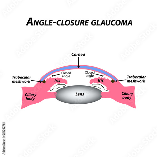 Closed angle glaucoma. A common type of glaucoma. The anatomical structure of the eye. Infographics. Vector illustration on isolated background.