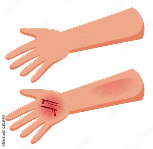 Set of injure hand