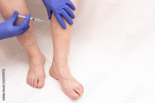The doctor makes an injection of sclerotherapy to the patient who has varicose veins in the legs, miniphlebectomy, copy space, treatment, vascular photo