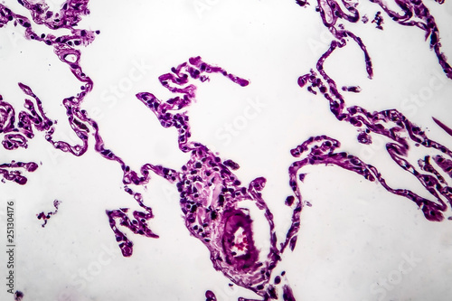 Histopathology of lung emphysema, light micrograph, photo under microscope showing enlargement of air spaces in lung tissue and destruction of alveolar septa