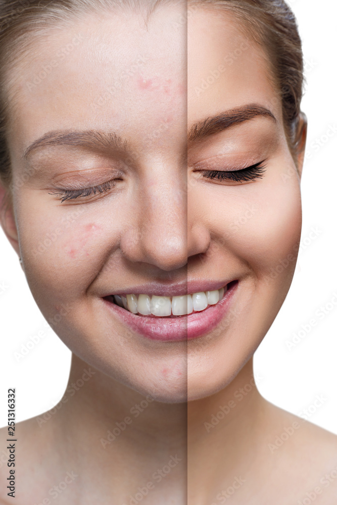 Young woman before and after skin treatment and makeup. Young woman before and after skin treatment and makeup.