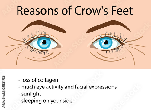 Reasons od Crows feet wrinkles, vector illustration