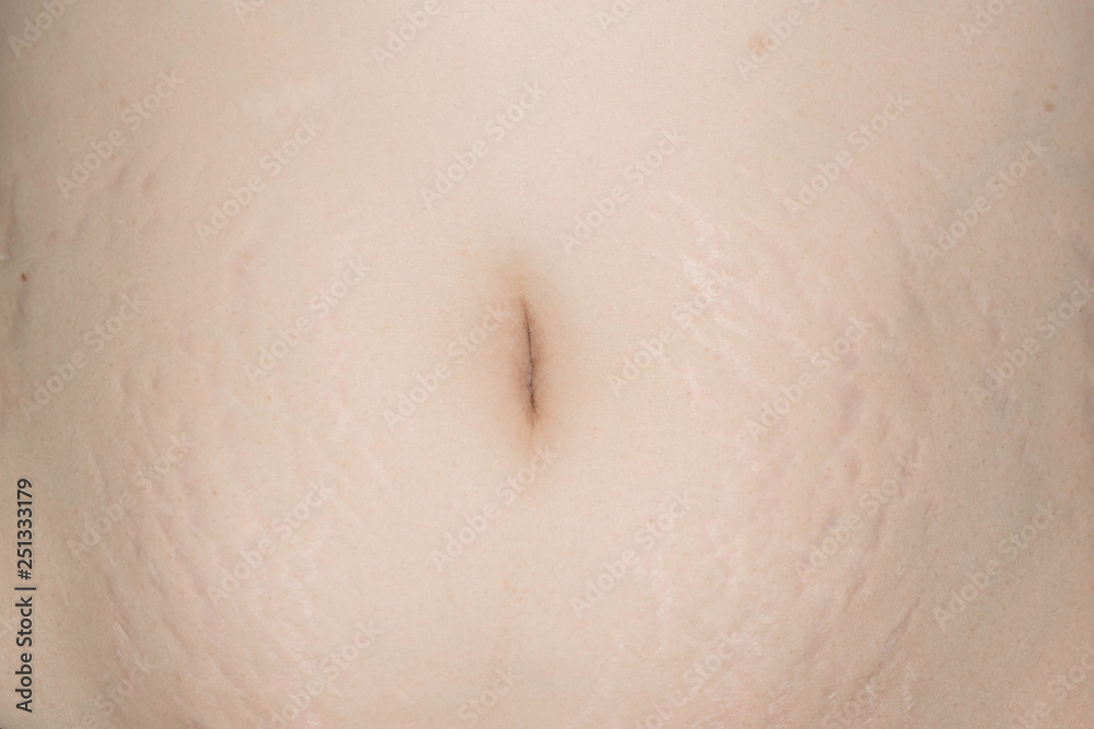 Fototapeta premium Stretch marks large on the skin of the abdomen of the woman after birth for medicine design