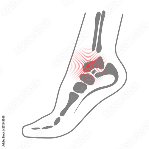 Foot Sole With Bones Illustration For Biomechanics, Footwear, Shoe Concepts, Medical, Health, Massage, Spa, Acupuncture Centers Etc. Pain Concept Isolated On A White Background. Vector Illustration