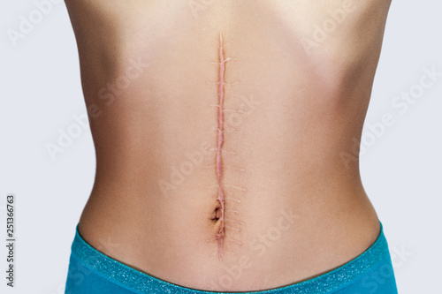 Fotografie, Obraz Closeup of young woman with large scar after surgery on abdomen