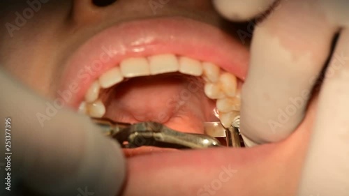 4K Close up of mouth and fillings and crowns on teeth with amalgam