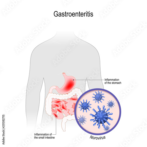 gastroenteritis. Viral disease that caused by noroviruses. photo