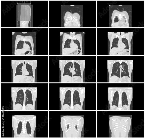 ct scan step set of body lung coronal view