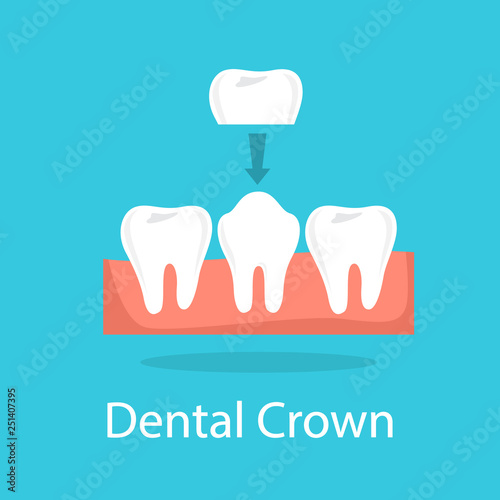 Tooth crown. Dentistry and implant procedure concept
