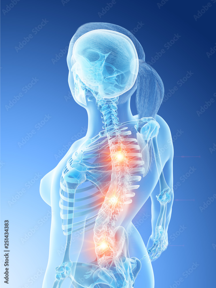 3d rendered illustration of a females painful back 3d rendered illustration of a females painful back