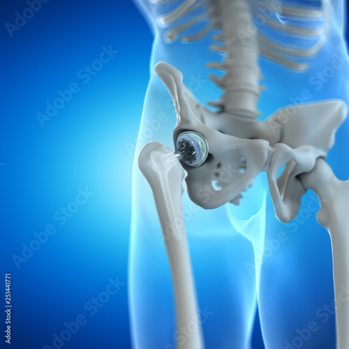 3d rendered illustration of a hip implant photo