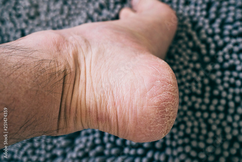 Dry and cracked skin on the heel of a Caucasian man