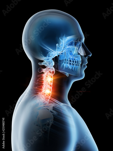 3d rendered illustration of a mans painful neck