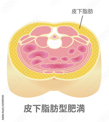 腹部断面図イラスト「肥満のタイプ」/ 皮下脂肪型肥満