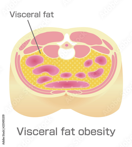 Type of obesity illustration . Abdominal sectional View (visceral fat ). 
