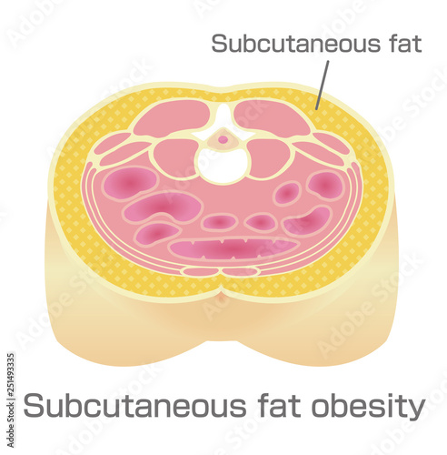 Type of obesity illustration . Abdominal sectional View (subcutaneous fat). 