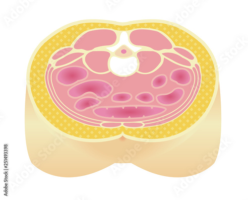 Type of obesity illustration . Abdominal sectional View (subcutaneous fat). 