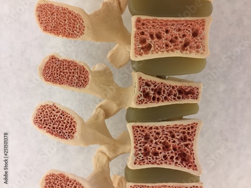 Old anatomical model of human spine showing vertebral disks, spinal canal and different levels of osteoporosis